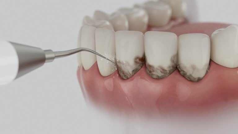 Trusted Wisdom Tooth Removal service in Cordry Sweetwater Lakes, IN - Dentist Open Now